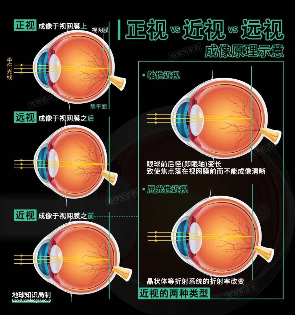 賭波：中國14億人，竟然有7億近眡眼？